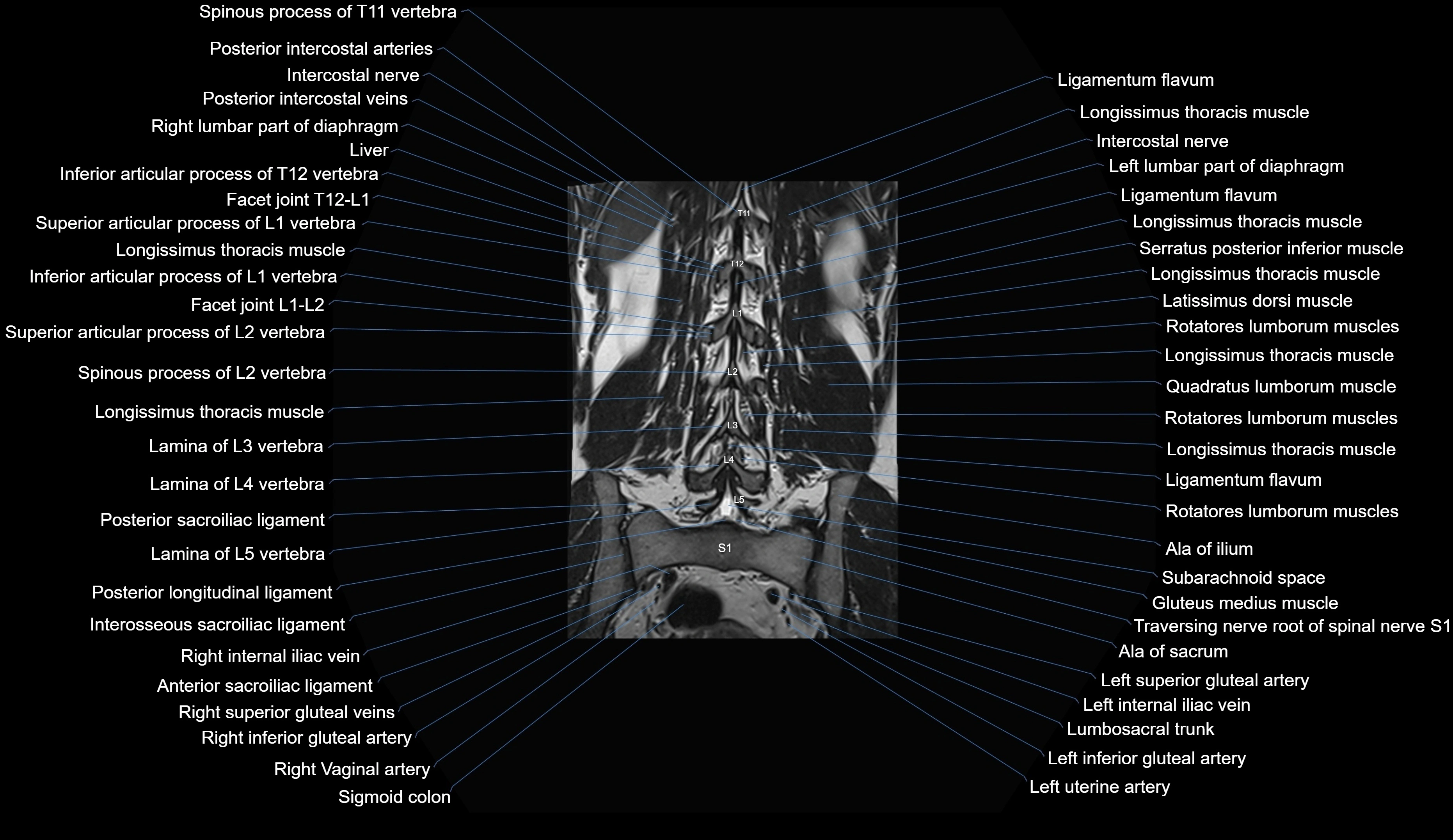 MRI lumbar spine coronal cross sectional anatomy 3T radiology  image-img-00001-00024.webp